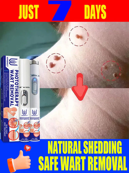 Safe Skin-Friendly Wart Removal Methods – Gentle Solutions for Effective Wart Treatment