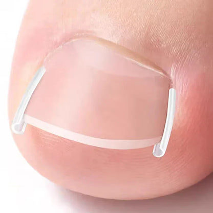 50PCS Ingrown Toenail Correction Kit – Invisible Nail Straightening Clips & Treatment Pads for Foot Care