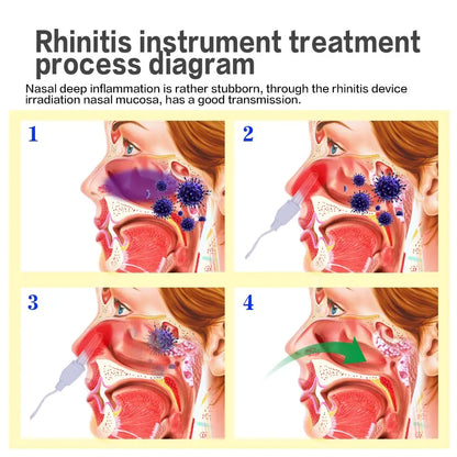 BioNase Laser Therapy for Rhinitis & Sinusitis – Low Frequency Pulse Nose Massage for Hay Fever & Runny Nose Treatment