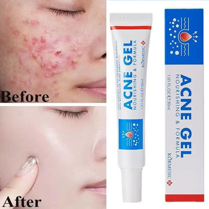 Effective Acne Removal Cream – Anti-Acne Gel for Redness, Pimples, Deep Pore Cleaning & Oil Control Skin Care