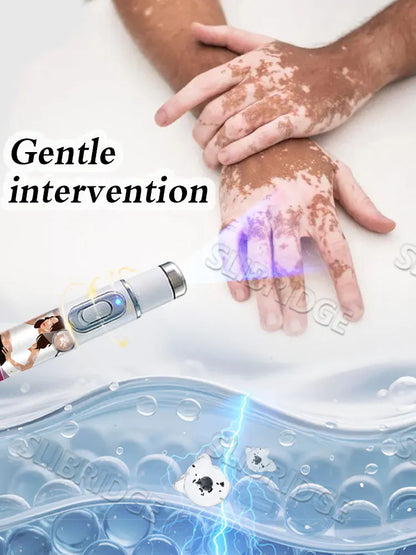 2025 Upgraded Blue Light Pen – Vitiligo Treatment Tool