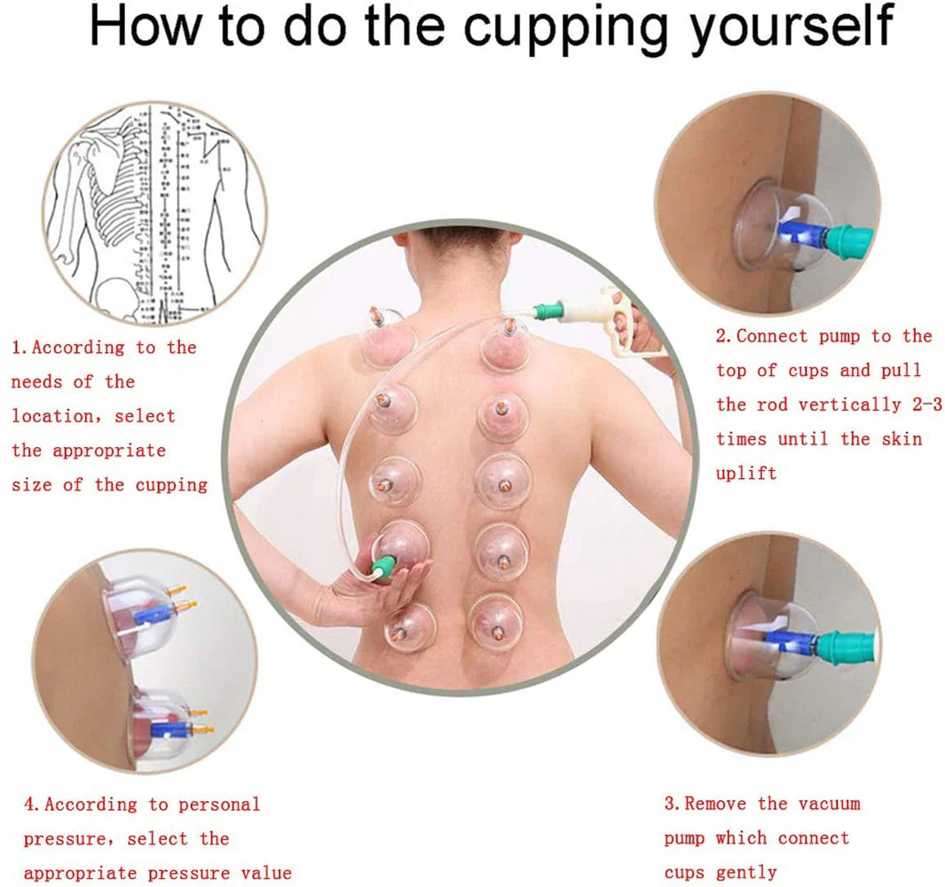 12/24-Cup Chinese Vacuum Cupping Therapy Set – Pull-Out Suction Massager for Pain Relief & Muscle Relaxation