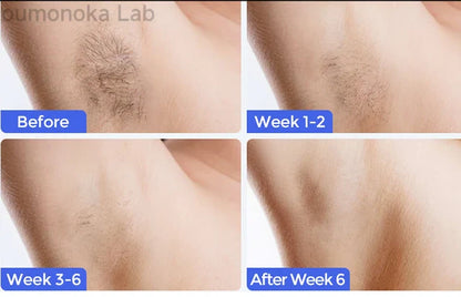 Body Bikini IPL Hair Removal Device – 999,999 Flashes, Permanent Painless Laser Epilator for Women, Home Use
