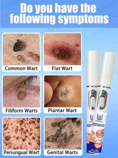 Safe Skin-Friendly Wart Removal Methods – Gentle Solutions for Effective Wart Treatment