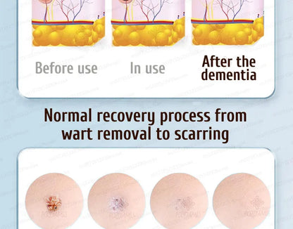 Safe Skin-Friendly Wart Removal Methods – Gentle Solutions for Effective Wart Treatment