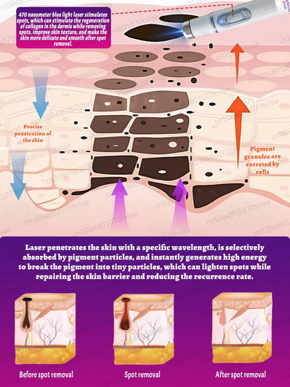 Freckle & Dark Spot Removal Treatment – Fade Chloasma, Age Spots, Acne Marks & Sun Spots