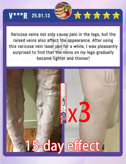 Varicose Vein & Spider Leg Pain Relief Treatment — Painless Care for Vasculitis & Phlebitis