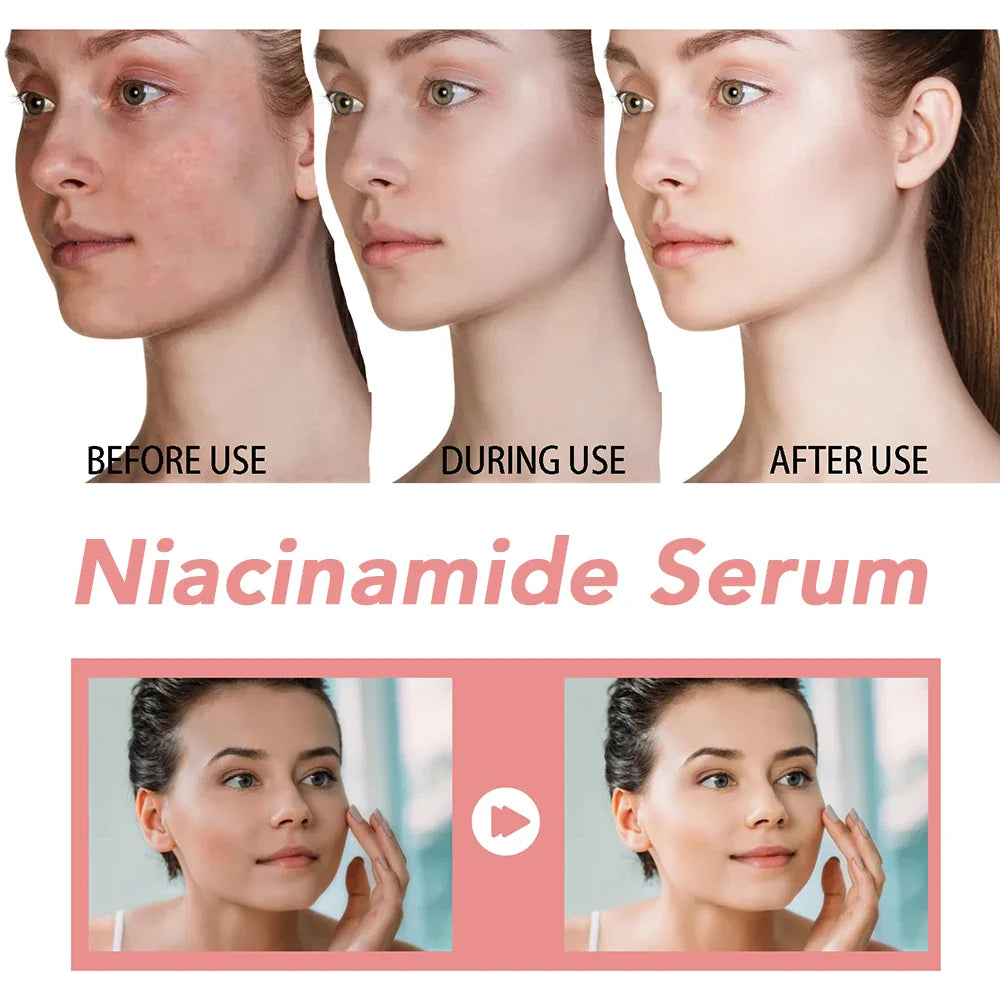 30ml Niacinamide Serum – Dark Spot Corrector, Melanin Removal & Pore-Shrinking Hydrating Skin Care