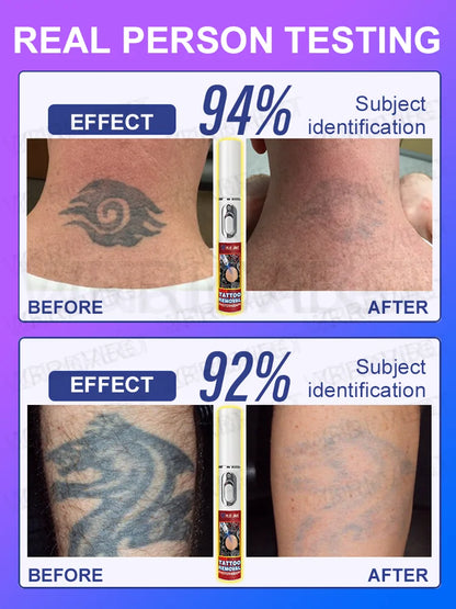 Laser Tattoo Removal Pen – Effective Portable Tattoo Eraser