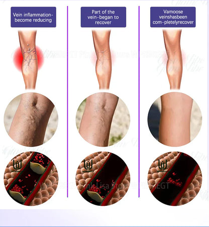 Varicose Vein & Spider Leg Pain Relief Treatment — Painless Care for Vasculitis & Phlebitis