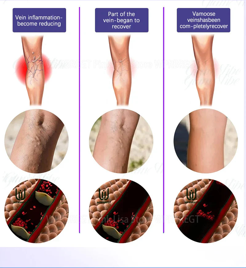2nd Gen Varicose Vein Laser Therapy Device – Relieves Spider Leg Pain, Treats Vasculitis & Phlebitis