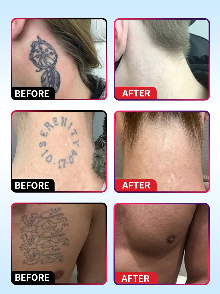 Quick Tattoo Removal Cream – Effective for Pigmented & Permanent Makeup Tattoo Removal