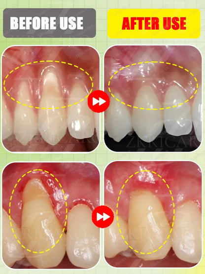 2025 Advanced Gum Care Device — Powerful Technology to Eliminate Gum Recession, Bleeding, and Tooth Pain