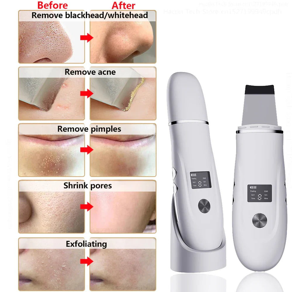 Ultrasonic Peeling Remover: Blackhead Facial Skin Scrubber Shovel for Deep Cleaning, Face Lifting, Pore Acne Removal - EMS Lift