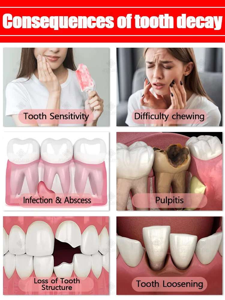 Rapid Cavity Repair Toothpaste – Effective Tooth Decay Treatment