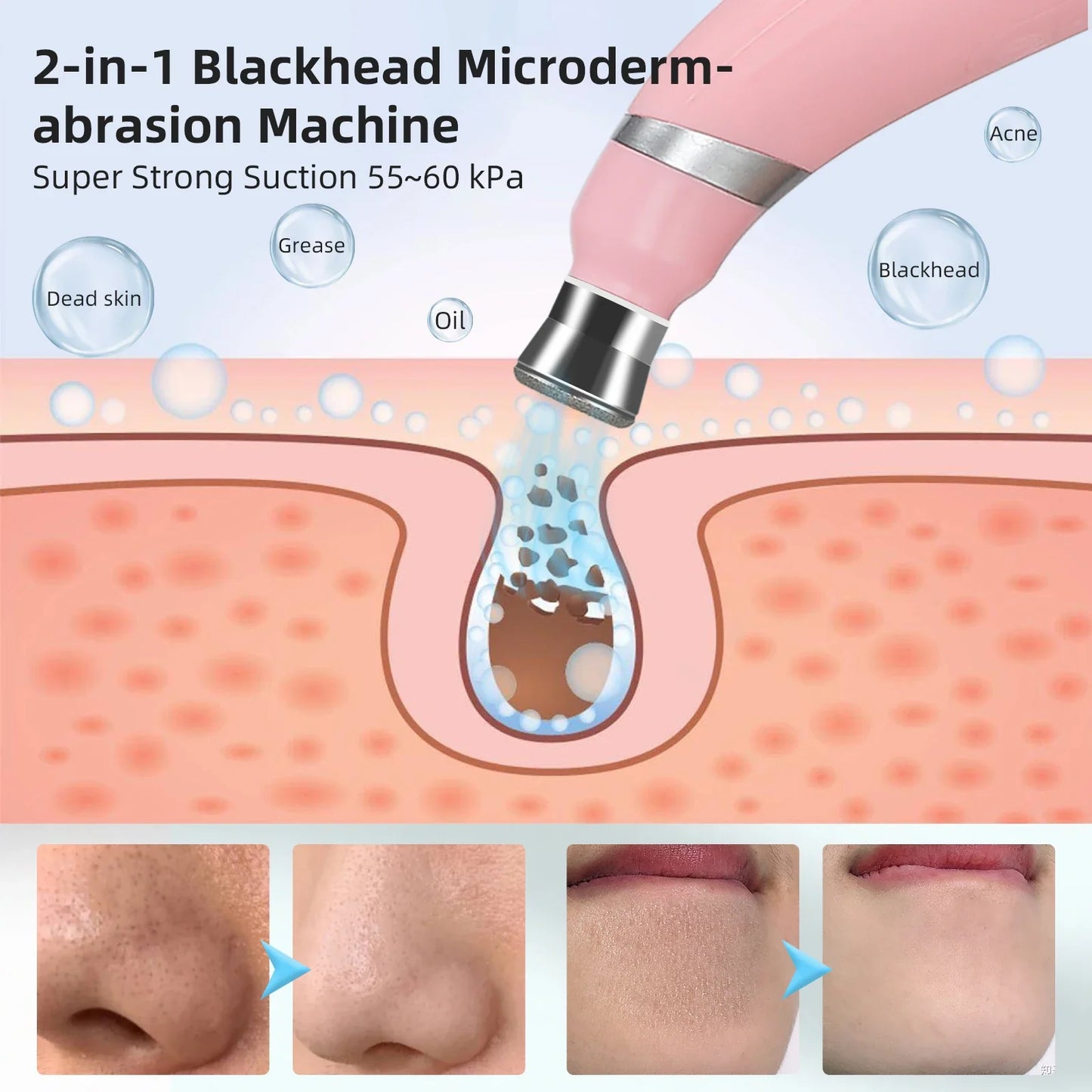Foreverlily Portable Diamond Peeling Machine – Microdermabrasion Facial Cleaner & Blackhead Remover Vacuum Device