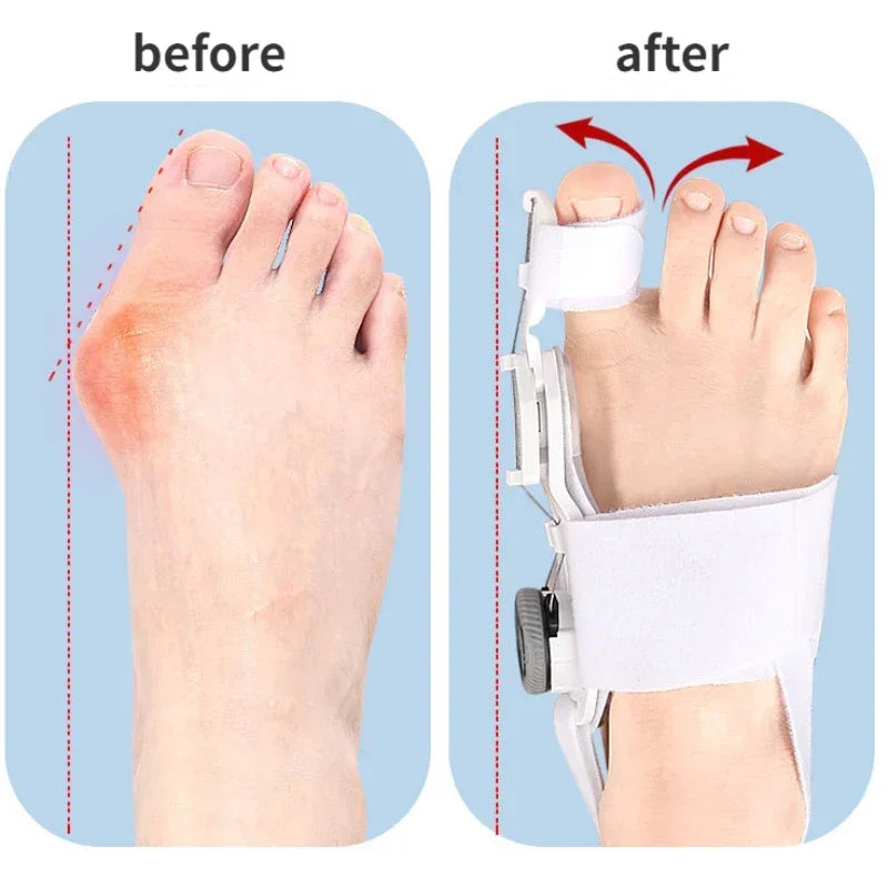 Bunion Corrector for Men & Women – Adjustable Hallux Valgus Toe Separator & Pedicure Straightener