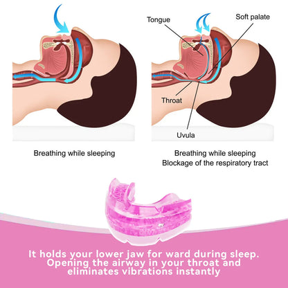 Anti-Snore Mouth Guard for Bruxism – Stop Snoring & Sleep Apnea Aid, Teeth Protection Night Mouthpiece