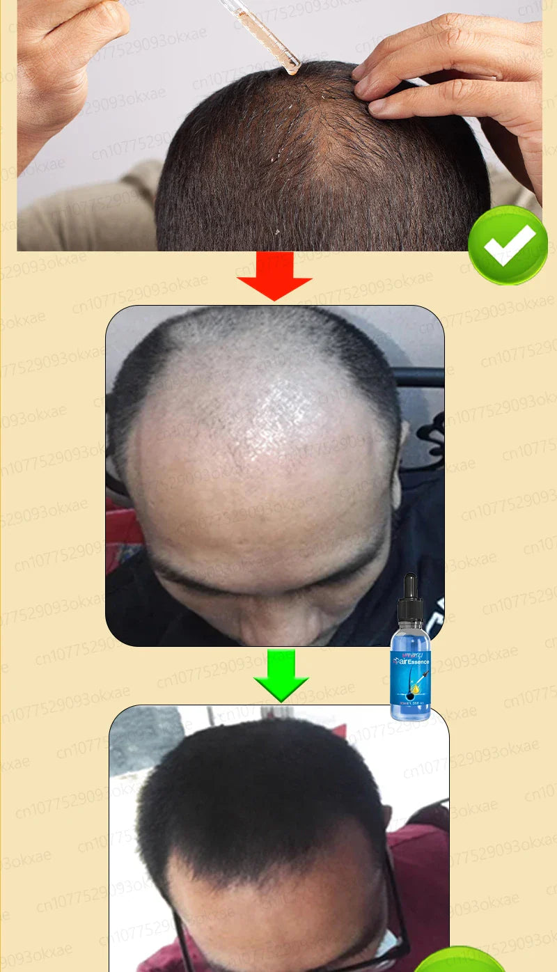 WPRBREGT Blue Hair Growth Serum — Essential Oil for Thicker Hair, Anti-Baldness Treatment