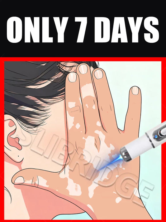 2025 Upgraded Blue Light Pen – Vitiligo Treatment Tool