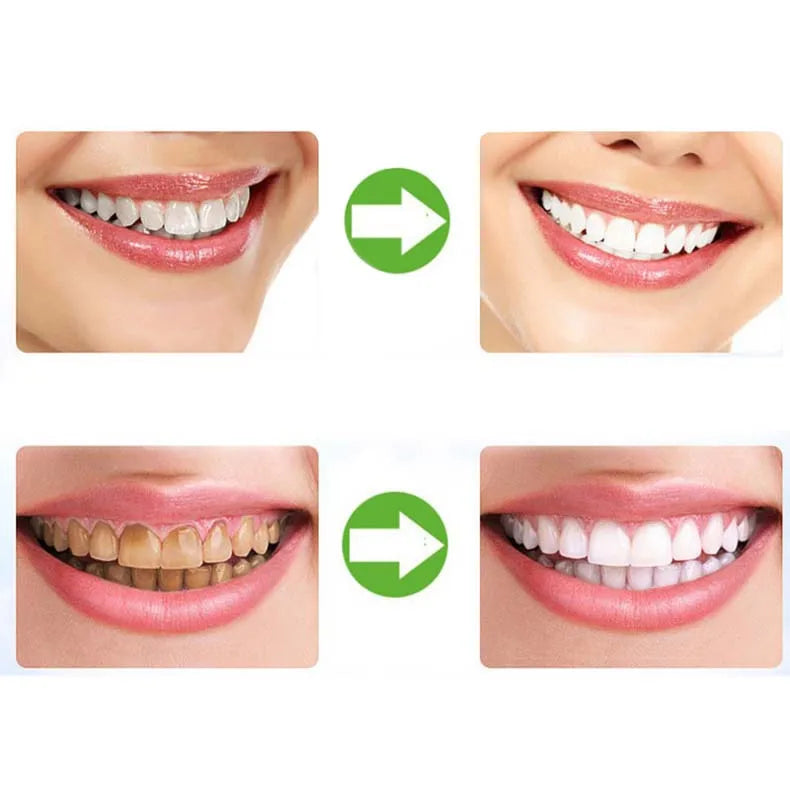 Silicone Dental Night Guard – Cold Light Whitening Braces Tray for Teeth Grinding Protection and Gum Cushion