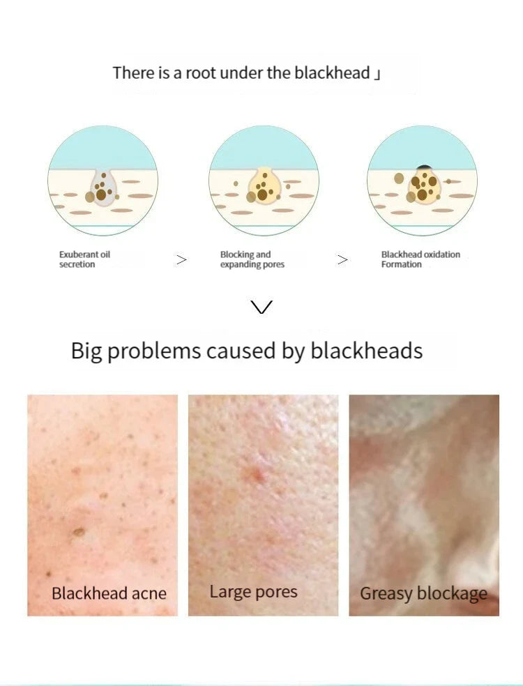 5PCS Blackhead Removal Nasal Strips – Acne & Pore Shrinking, Deep Cleaning Magic Adsorption for Smooth Skin
