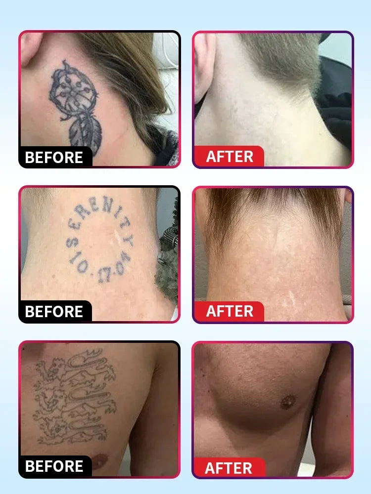 Tattoo Removal Cream – Effective for Large & Small Permanent Tattoos