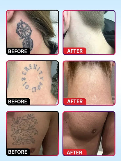 Tattoo Removal Cream – Effective for Large & Small Permanent Tattoos