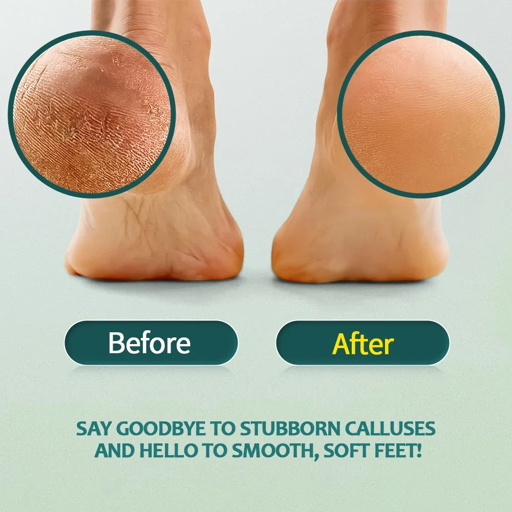 NAILPOP Extra Strength Callus Remover & Foot File Kit - Fast Hard Skin, Heel & Tough Callus Removal