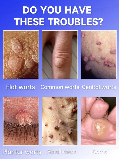 Quick Wart & Sarcoma Removal Treatment – Fast & Effective Skin Care Solution