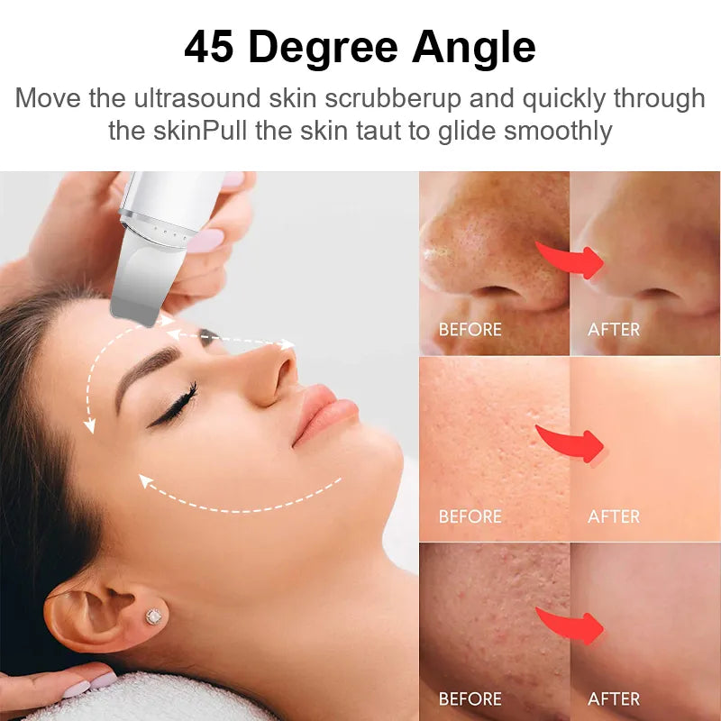 Ultrasonic Skin Scrubber - Vibration Face Spatula for Blackhead Removal, Deep Cleaning, Cavitation Peeling, and Facial Lifting Skincare