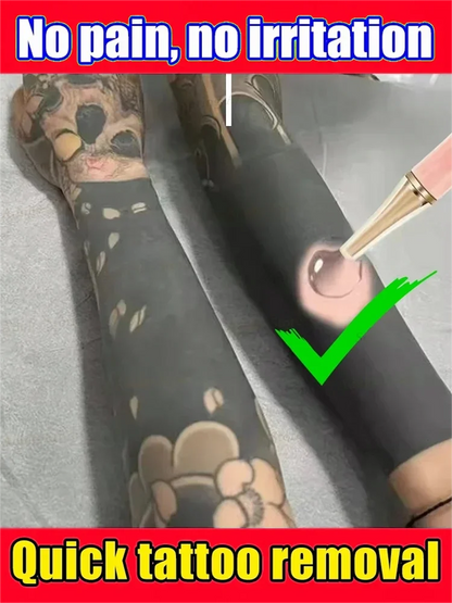 Tattoo Removal Cream – Effective for Large & Small Permanent Tattoos