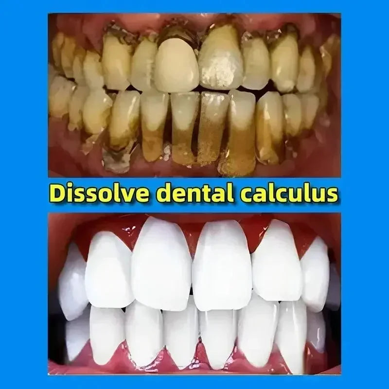 Dental Calculus Remover & Whitening Toothpaste – Fresh Breath & Periodontitis Prevention