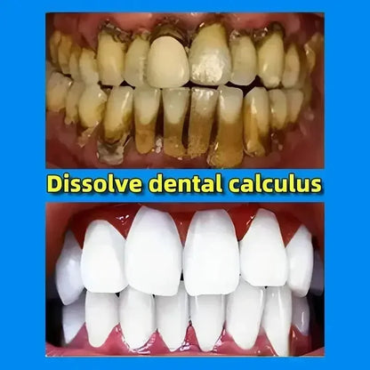 Dental Calculus Remover & Whitening Toothpaste – Fresh Breath & Periodontitis Prevention