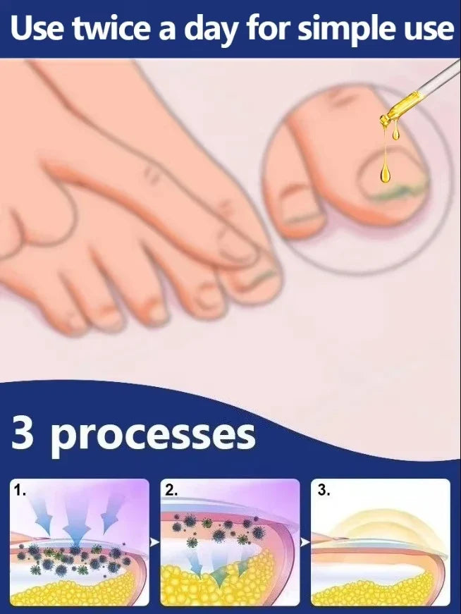Fast Nail Fungus Treatment Solution – Restore Healthy Looking Nails Quickly & Effectively