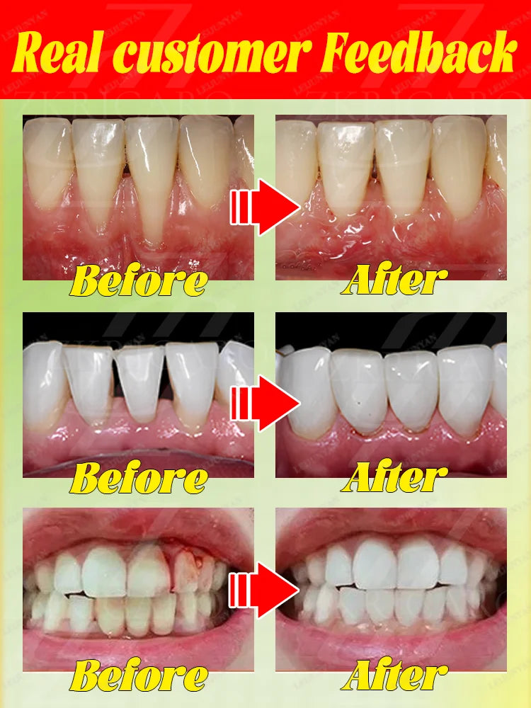 2025 Advanced Gum Care Device — Powerful Technology to Eliminate Gum Recession, Bleeding, and Tooth Pain