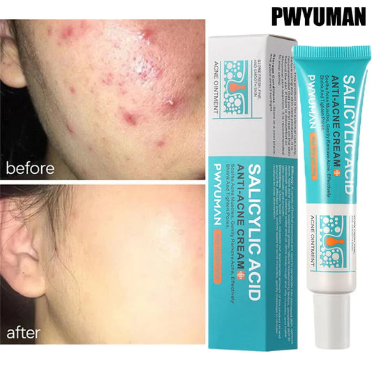 Salicylic Acid Acne Removal Cream – Anti-Acne, Redness Repair, Deep Cleaning & Oil Control Skincare