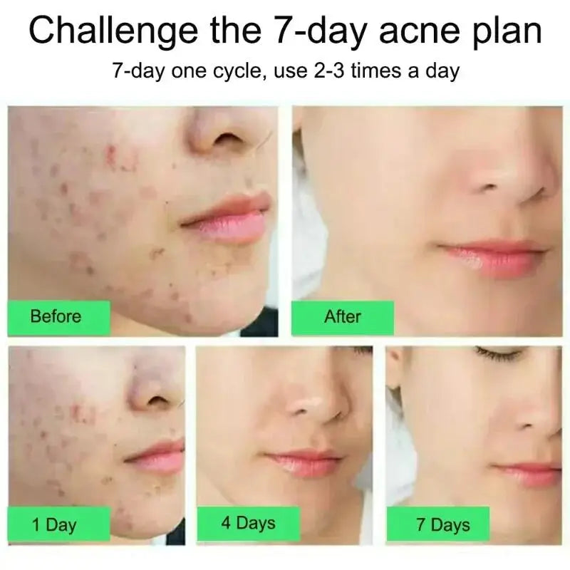 Salicylic Acid Acne Removal Cream – Anti-Acne, Redness Repair, Deep Cleaning & Oil Control Skincare