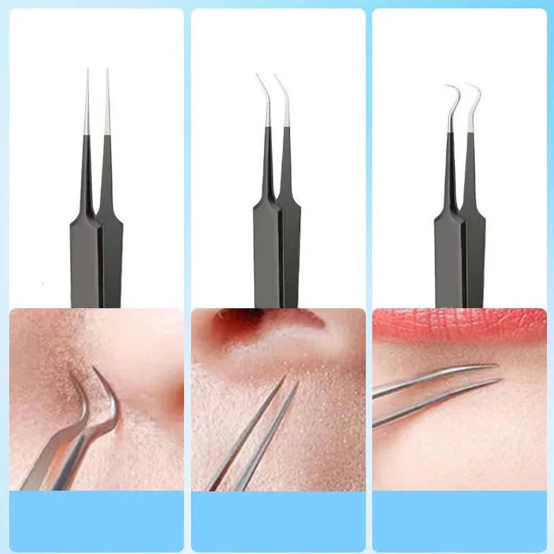 4/6PCS Face Cleaning Kit – Pimple, Blackhead & Whitehead Remover Tools for Acne and Comedone Care