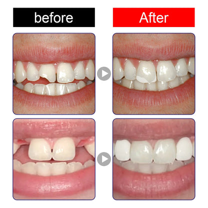 Temporary Tooth Repair Resin – 10/20/30ML Shapeable Dental Glue for Filling Broken Teeth, Dentures & Halloween Fangs