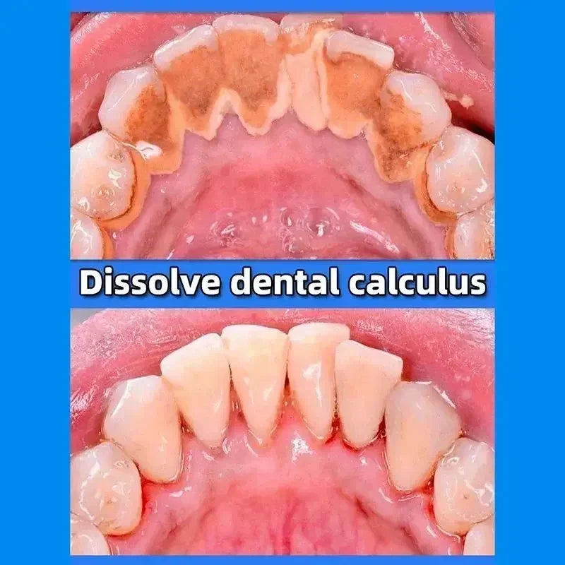 Dental Calculus Remover & Whitening Toothpaste – Fresh Breath & Periodontitis Prevention