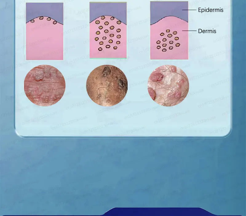 Safe Skin-Friendly Wart Removal Methods – Gentle Solutions for Effective Wart Treatment