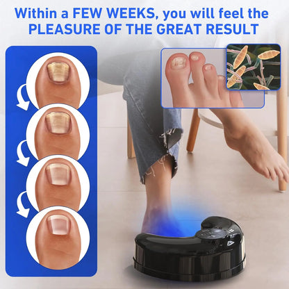 Wireless Toenail Fungus Laser Treatment Device – 470nm & 910nm Blue Light Anti-Fungal Therapy Tool