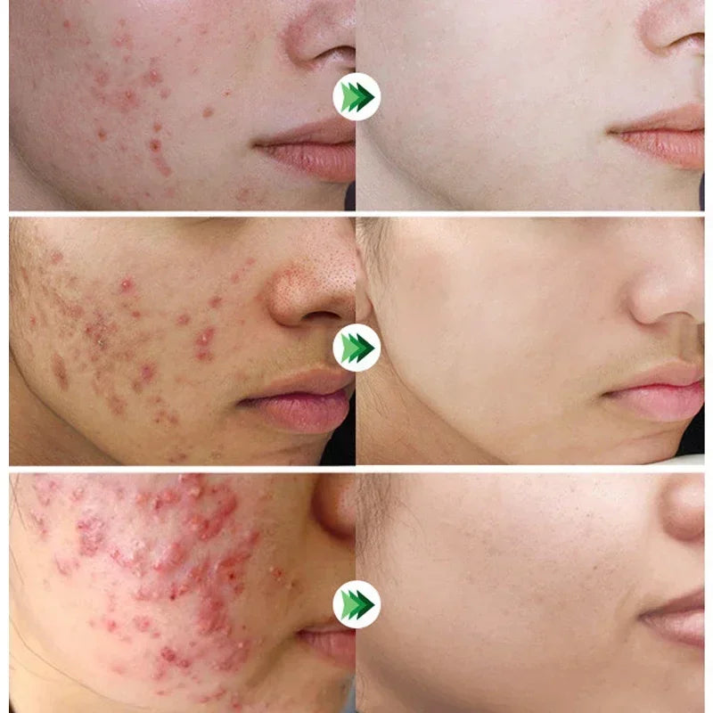 Effective Acne Removal Cream – Anti-Acne Gel for Redness, Pimples, Deep Pore Cleaning & Oil Control Skin Care