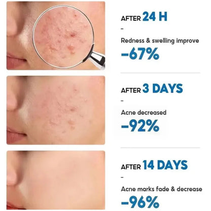 Effective Acne Removal Cream 30g – Anti-Acne Gel for Redness, Pimples, Deep Pore Cleaning & Oil Control Skin Care