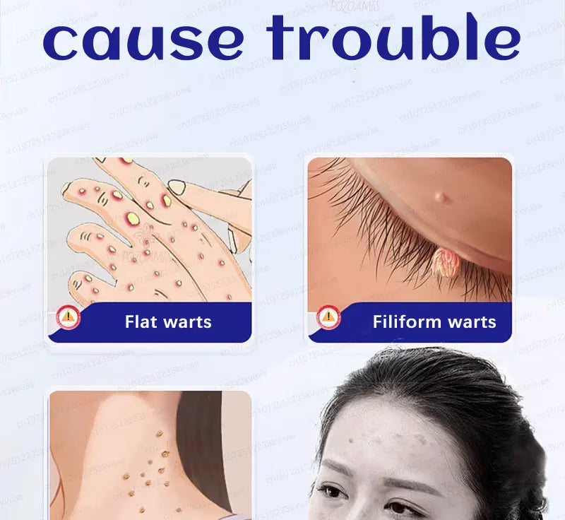 Safe Skin-Friendly Wart Removal Methods – Gentle Solutions for Effective Wart Treatment