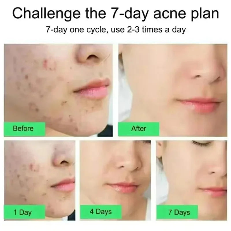 Effective Acne Removal Cream 30g – Anti-Acne Gel for Redness, Pimples, Deep Pore Cleaning & Oil Control Skin Care