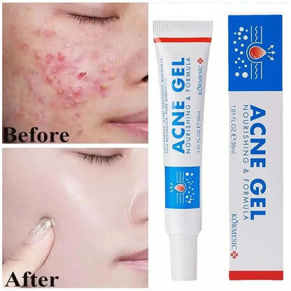 Effective Acne Removal Cream 30g – Anti-Acne Gel for Redness, Pimples, Deep Pore Cleaning & Oil Control Skin Care