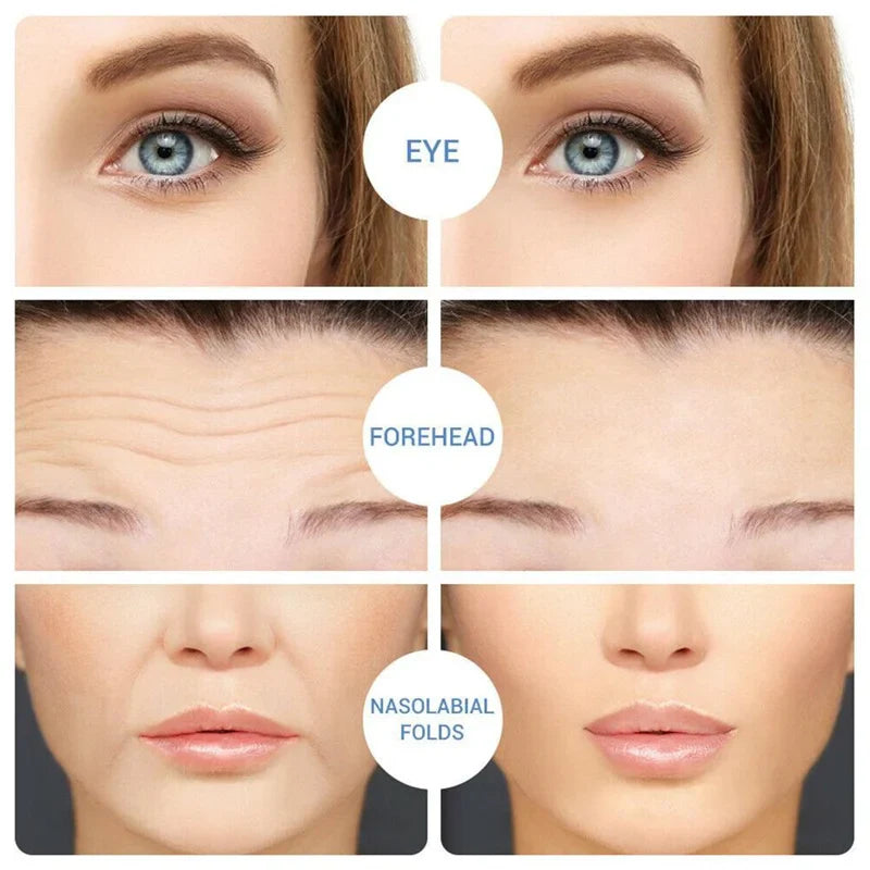 Micro-Needle Hyaluronic Acid Eye Patch – Anti-Wrinkle Moisturizing Eye Mask for Fine Lines Removal