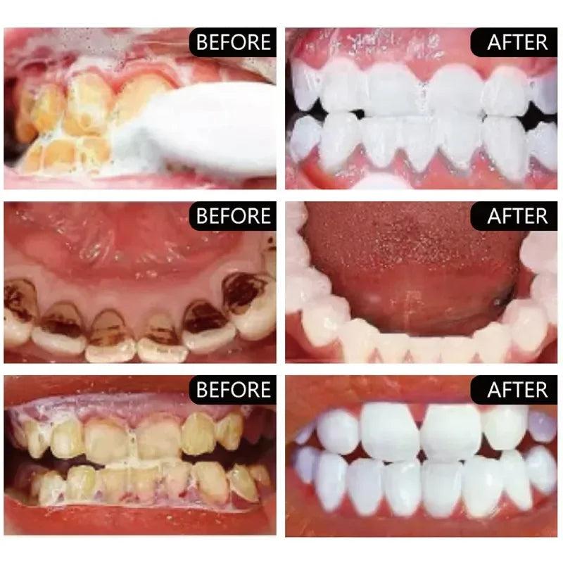 5 Day Teeth Whitening Powder – Removes Plaque & Stains, Deep Cleaning, Fresh Breath & Oral Hygiene Care
